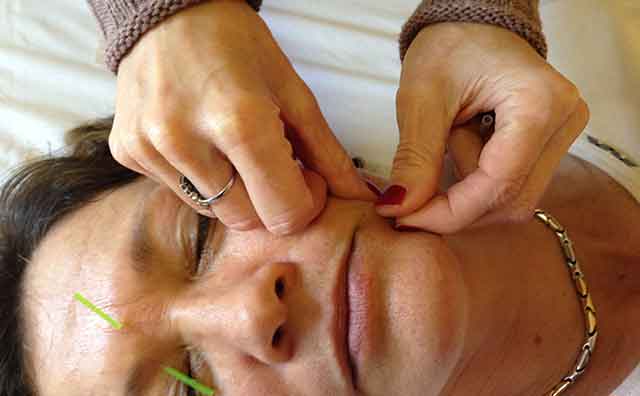 Facial acupuncture treatment