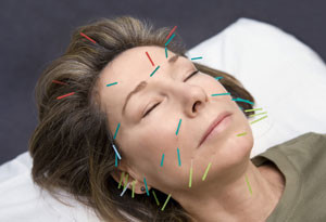 cosmetic-acupuncture